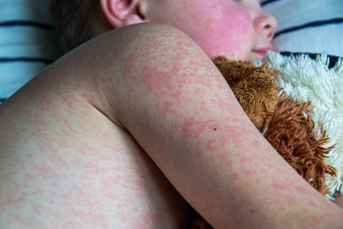 Child with measles rash